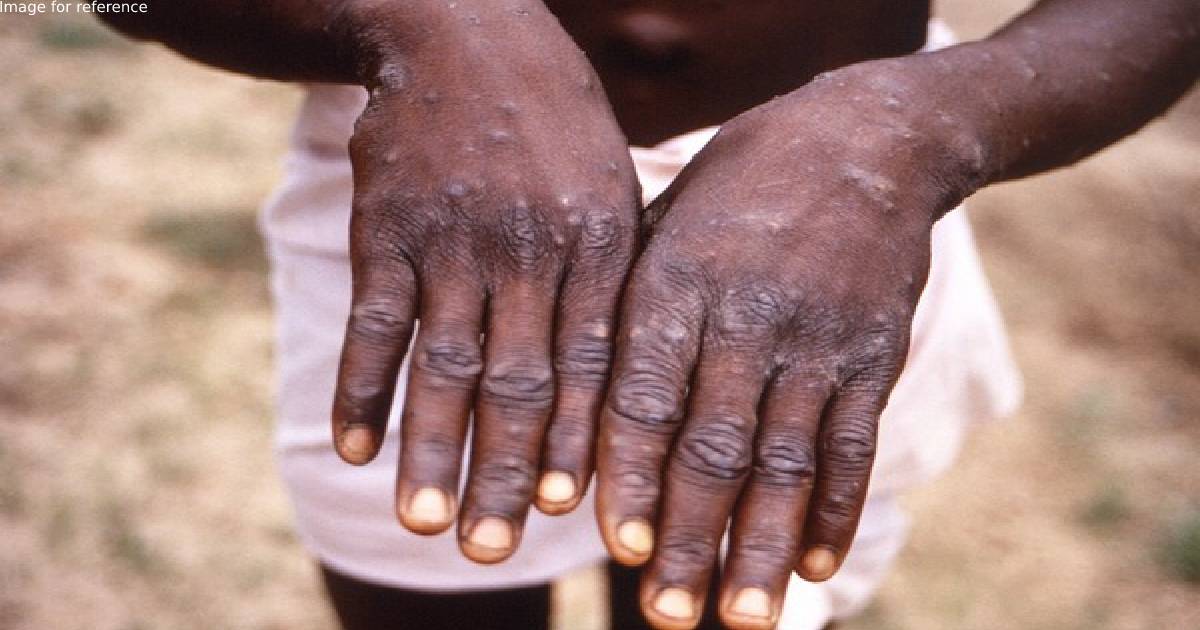 India reports second confirmed Monkeypox case from Kerala
